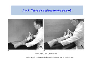 A e B Teste do deslocamento do pivô
Fonte: Magee, D J; Orthopedic Physical Assessment , 4th Ed., Elseiver- 2002
 