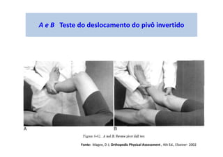 A e B Teste do deslocamento do pivô invertido
Fonte: Magee, D J; Orthopedic Physical Assessment , 4th Ed., Elseiver- 2002
 