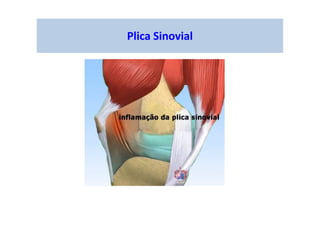 Plica Sinovial
 