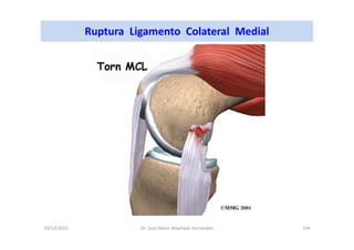 10/12/2015 Dr. José Heitor Machado Fernandes 144
Ruptura Ligamento Colateral Medial
 