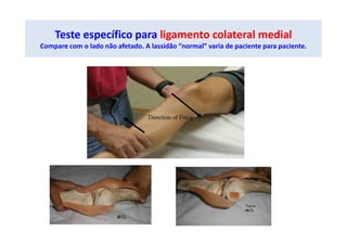 Teste específico para ligamento colateral medial
Compare com o lado não afetado. A lassidão “normal” varia de paciente para paciente.
 