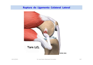 10/12/2015 Dr. José Heitor Machado Fernandes 147
Ruptura do Ligamento Colateral Lateral
 