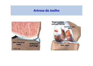 Artrose do Joelho
 
