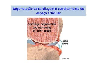 Degeneração da cartilagem e estreitamento do
espaço articular
 