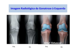 Imagem Radiológica da Gonatrose à Esquerda
Esq. Esq.Dir. Dir.
 