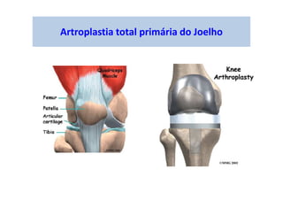 Artroplastia total primária do Joelho
 