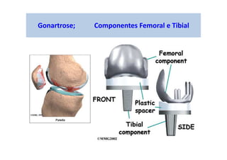 Gonartrose; Componentes Femoral e Tibial
 