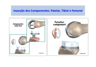 Inserção dos Componentes: Patelar, Tibial e Femoral
 