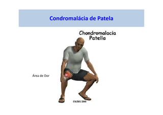figura
Condromalácia de Patela
Área de Dor
 
