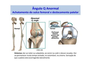 Ângulo Q Anormal
Achatamento do sulco femoral e deslocamento patelar
Sintomas: dor ao redor ou subpatelar, ao correr ou subir e descer escadas. Dor
ao permanecer muito tempo sentado, no automóvel, no cinema. Sensação de
que a patela está escorregando lateralmente.
 