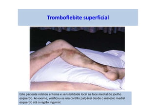 Este paciente relatou eritema e sensibilidade local na face medial do joelho
esquerdo. Ao exame, verificou-se um cordão palpável desde o maléolo medial
esquerdo até a região inguinal.
Tromboflebite superficial
 