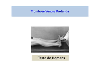 Trombose Venosa Profunda
Teste de Homans
 