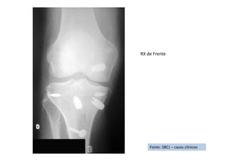 Fonte: SBCJ – casos clínicos
RX de Frente
 