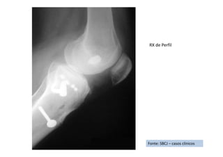 Fonte: SBCJ – casos clínicos
RX de Perfil
 