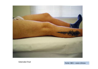 Fonte: SBCJ – casos clínicos
Extensão Final
 