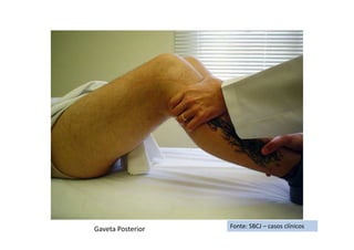 Fonte: SBCJ – casos clínicosGaveta Posterior
 