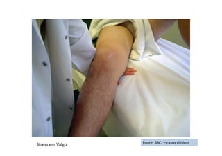 Fonte: SBCJ – casos clínicosStress em Valgo
 