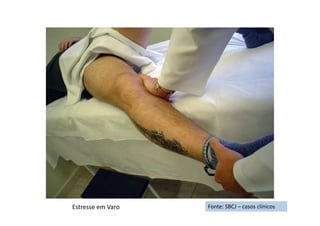 Fonte: SBCJ – casos clínicosEstresse em Varo
 