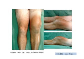 figura
Fonte: SBCJ – casos clínicos
imagem clinica 2007 (antes da última cirurgia)
 
