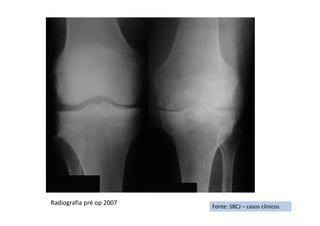 Fonte: SBCJ – casos clínicos
Radiografia pré op 2007
 