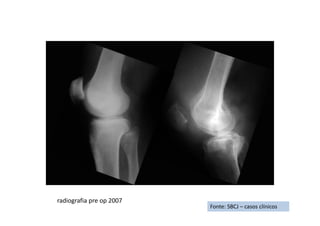 Fonte: SBCJ – casos clínicos
radiografia pre op 2007
 