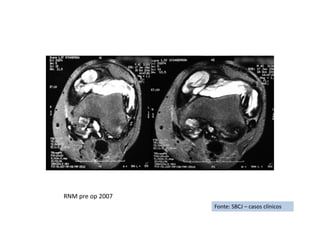 figura
Fonte: SBCJ – casos clínicos
RNM pre op 2007
 