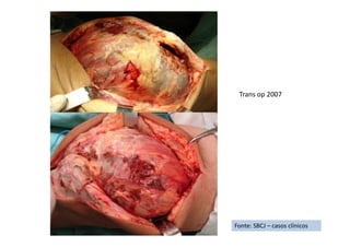 Fonte: SBCJ – casos clínicos
Trans op 2007
 