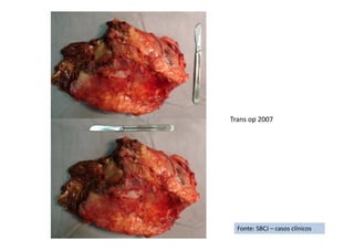 Fonte: SBCJ – casos clínicos
Trans op 2007
 