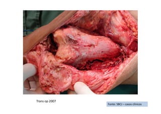 Fonte: SBCJ – casos clínicos
Trans op 2007
 