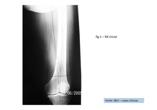 Fonte: SBCJ – casos clínicos
fig 1 – RX inicial
 