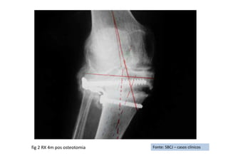 Fonte: SBCJ – casos clínicosfig 2 RX 4m pos osteotomia
 