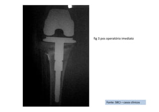 Fonte: SBCJ – casos clínicos
fig 3 pos operatório imediato
 