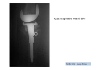 Fonte: SBCJ – casos clínicos
fig 3a pos operatorio imediato perfil
 