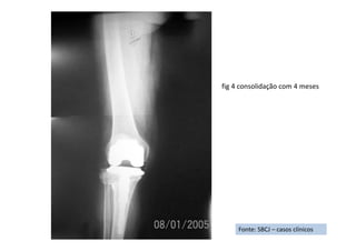 Fonte: SBCJ – casos clínicos
fig 4 consolidação com 4 meses
 