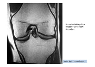 Fonte: SBCJ – casos clínicos
Ressonância Magnética
do Joelho Direito sem
alterações.
 