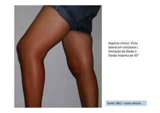 Fonte: SBCJ – casos clínicos
Aspecto clínico: Vista
lateral em ortostase (
limitação da flexão )-
Flexão máxima de 45°
 