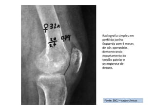 Fonte: SBCJ – casos clínicos
Radiografia simples em
perfil do joelho
Esquerdo com 4 meses
de pós-operatório,
demonstrando
encurtamento do
tendão patelar e
osteoporose de
desuso.
 