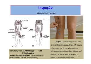 Inspeção
vista anterior de pé
Ângulo Q = formado por uma linha
conectando o centro da patela à EIAS e outra
linha em direção da inserção patelar na
tuberosidade anterior da tíbia. Valor normal
máximo é de 20°. A partir desse valor o
ângulo é considerado aumentado
Identificação de A) joelho valgo e de
B) joelho varo;
Anormalidades patelares, como patela alta,
patela baixa e patelas medializadas;
 