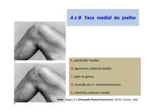 A e B Face medial do joelho
A, epicôndilo medial;
B, ligamento colateral medial;
C, pata de ganso;
D, inserção do m. semimembranoso;
E, interlinha articular medial
Fonte: Magee, D J; Orthopedic Physical Assessment , 4th Ed., Elseiver- 2002
 