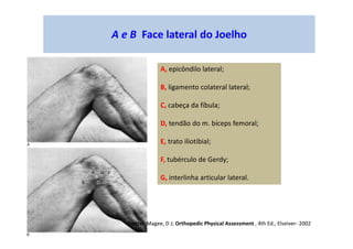 A e B Face lateral do Joelho
A, epicôndilo lateral;
B, ligamento colateral lateral;
C, cabeça da fíbula;
D, tendão do m. bíceps femoral;
E, trato iliotibial;
F, tubérculo de Gerdy;
G, interlinha articular lateral.
Fonte: Magee, D J; Orthopedic Physical Assessment , 4th Ed., Elseiver- 2002
 