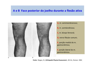 A e B Face posterior do joelho durante a flexão ativa
A, m. semimembranoso;
B, m. semitendinoso;
C, m. bíceps femoral;
D, nervo fibular comum;
E, porção medial do m.
gastrocnêmico;
F, porção lateral do m.
gastrocnêmico.
Fonte: Magee, D J; Orthopedic Physical Assessment , 4th Ed., Elseiver- 2002
 