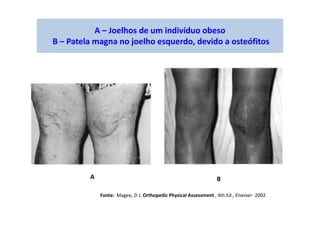 A – Joelhos de um indivíduo obeso
B – Patela magna no joelho esquerdo, devido a osteófitos
A B
Fonte: Magee, D J; Orthopedic Physical Assessment , 4th Ed., Elseiver- 2002
 