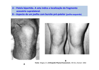 A – Patela bipartida. A seta indica a localização do fragmento
acessório supralateral.
B – Aspecto de um joelho com bursite pré-patelar (joelho esquerdo)
A
B
Fonte: Magee, D J; Orthopedic Physical Assessment , 4th Ed., Elseiver- 2002
 