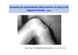 Aumento da tuberosidade tibial anterior na doença de
Osgood-Schlatter (seta)
Fonte: Magee, D J; Orthopedic Physical Assessment , 4th Ed., Elseiver- 2002
 