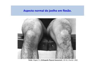 Aspecto normal do joelho em flexão.
Fonte: Magee, D J; Orthopedic Physical Assessment , 4th Ed., Elseiver- 2002
 