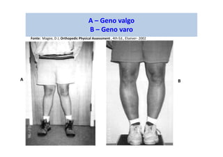 A – Geno valgo
B – Geno varo
A B
Fonte: Magee, D J; Orthopedic Physical Assessment , 4th Ed., Elseiver- 2002
 
