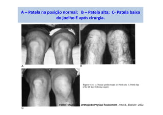 A – Patela na posição normal; B – Patela alta; C- Patela baixa
do joelho E após cirurgia.
Fonte: Magee, D J; Orthopedic Physical Assessment , 4th Ed., Elseiver- 2002
 
