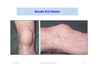 10/12/2015 Dr. José Heitor M. Fernandes 63
Bursite Pré-Patelar
 