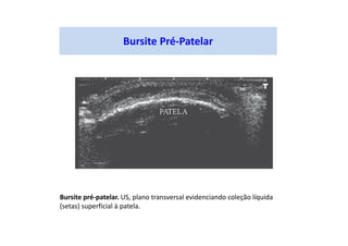Bursite pré-patelar. US, plano transversal evidenciando coleção líquida
(setas) superficial à patela.
Bursite Pré-Patelar
 