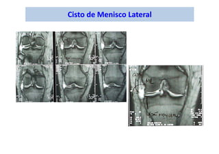 Cisto de Menisco Lateral
 